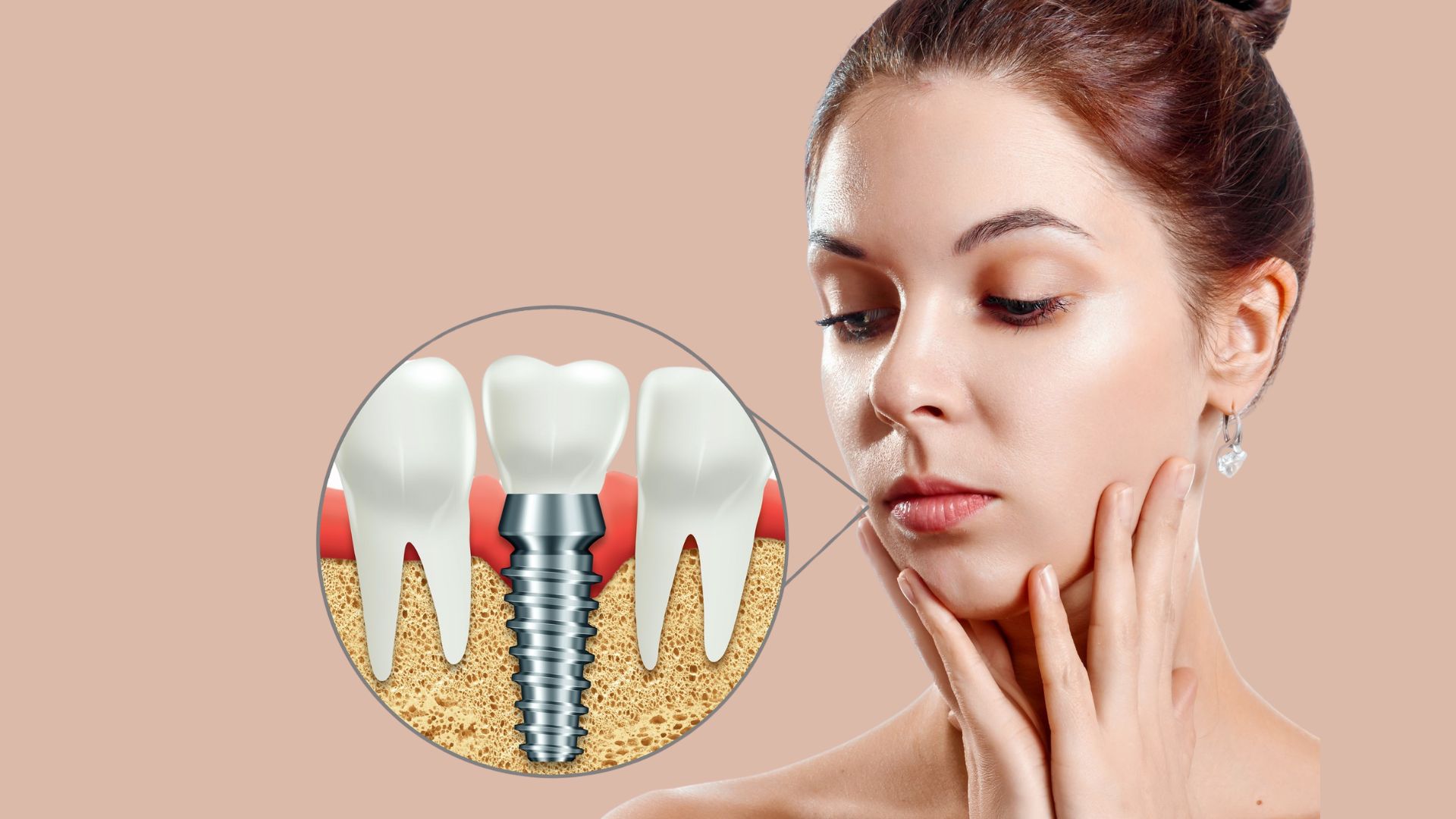 dental implants